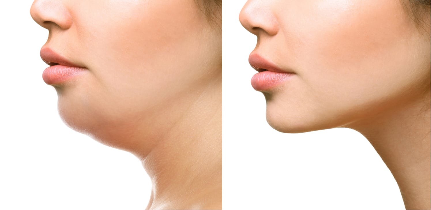 Considering Kybella?: Everything You Need to Know Before Treatment