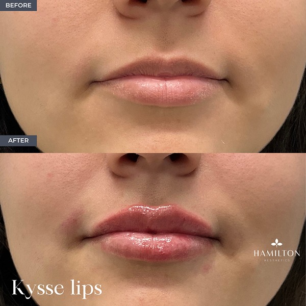 LIP B&A 1