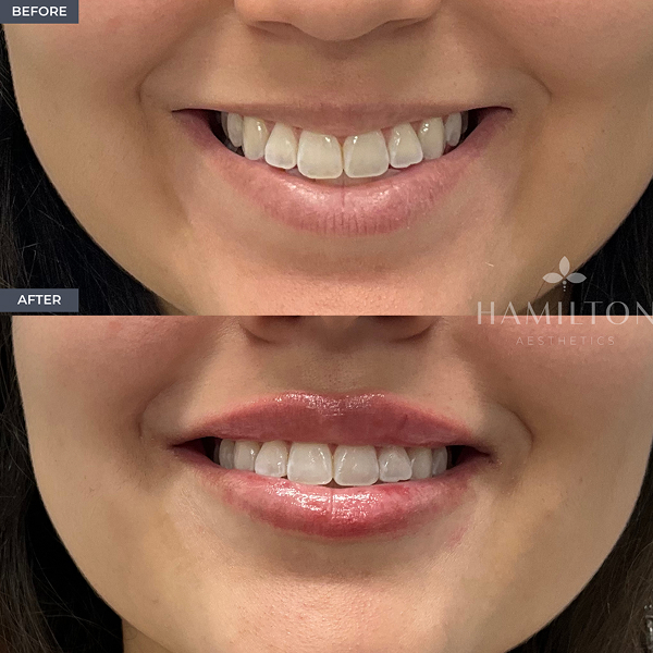 LIP B&A 2